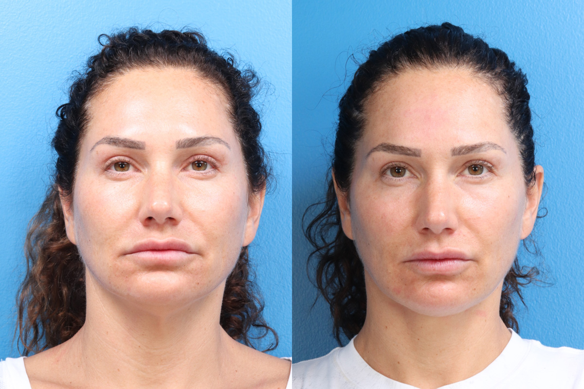 Ellevate Facial Rejuvenation Sanctuary Plastic Surgery