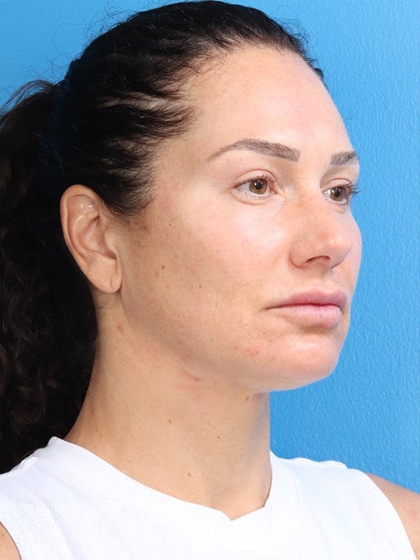 MyEllevate™ Before & After Gallery - Patient 62195309 - Image 4
