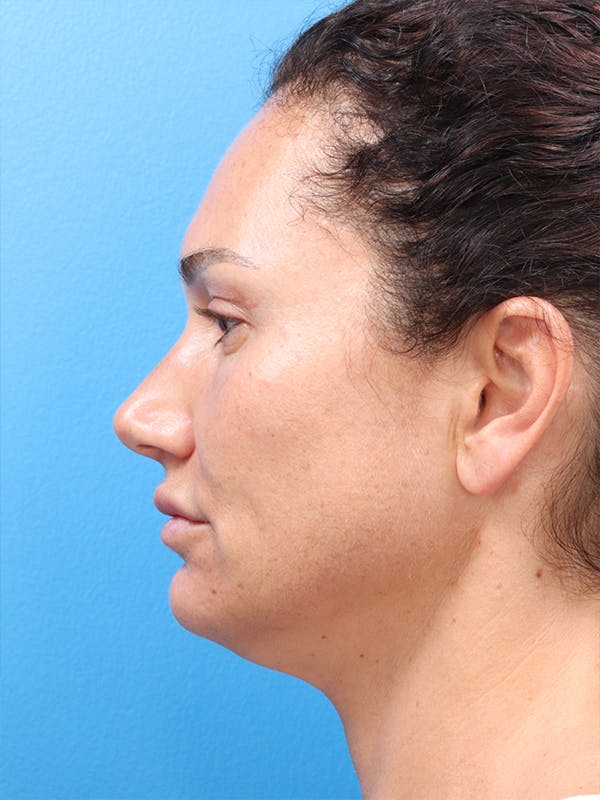 MyEllevate™ Before & After Gallery - Patient 62195309 - Image 5