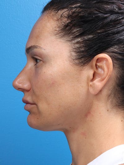 MyEllevate™ Before & After Gallery - Patient 62195309 - Image 6