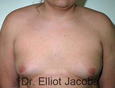 Adolescent Gynecomastia Before & After Gallery - Patient 120163367 - Image 1