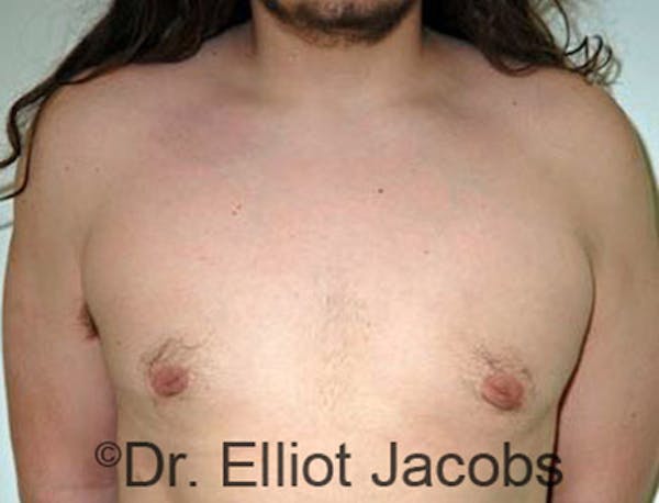 Adolescent Gynecomastia Before & After Gallery - Patient 120163367 - Image 2