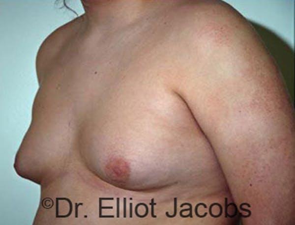 Adolescent Gynecomastia Before & After Gallery - Patient 120163367 - Image 3