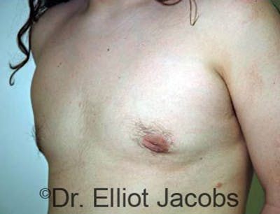 Adolescent Gynecomastia Before & After Gallery - Patient 120163367 - Image 4