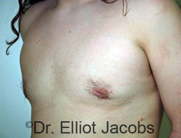 Adolescent Gynecomastia Before & After Gallery - Patient 120163367 - Image 4