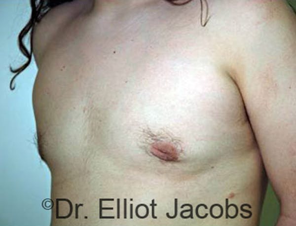 Adolescent Gynecomastia Before & After Gallery - Patient 120163367 - Image 4
