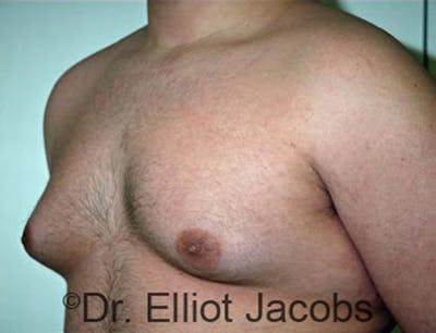 Adolescent Gynecomastia Before & After Gallery - Patient 120163368 - Image 1