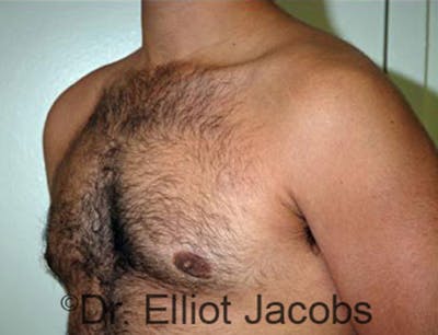 Adolescent Gynecomastia Before & After Gallery - Patient 120163368 - Image 2