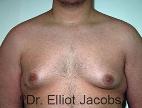 Adolescent Gynecomastia Before & After Gallery - Patient 120163368 - Image 3