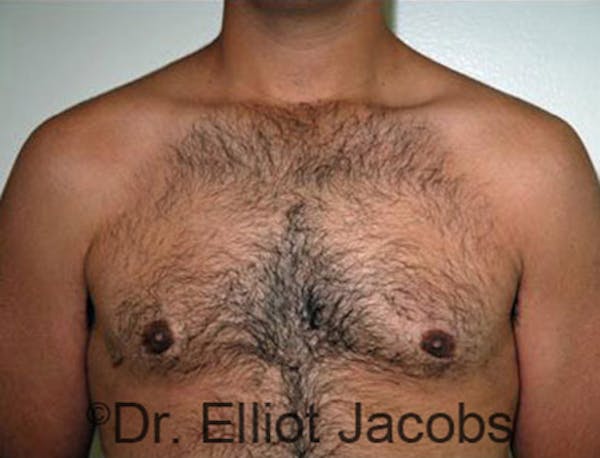 Adolescent Gynecomastia Before & After Gallery - Patient 120163368 - Image 4