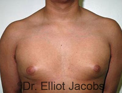 Adolescent Gynecomastia Before & After Gallery - Patient 120163369 - Image 1