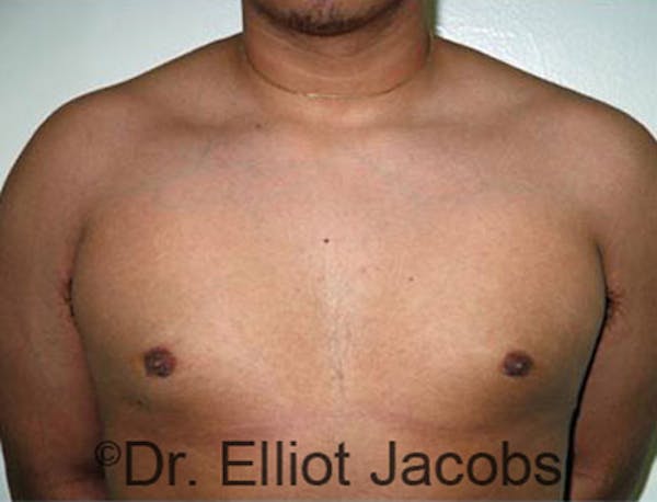 Adolescent Gynecomastia Before & After Gallery - Patient 120163369 - Image 2