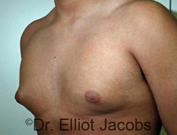 Adolescent Gynecomastia Before & After Gallery - Patient 120163369 - Image 3
