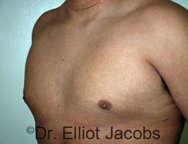 Adolescent Gynecomastia Before & After Gallery - Patient 120163369 - Image 4