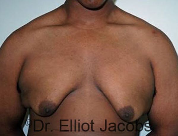 Adolescent Gynecomastia Before & After Gallery - Patient 120163374 - Image 1