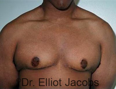 Adolescent Gynecomastia Before & After Gallery - Patient 120163374 - Image 2