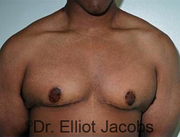 Adolescent Gynecomastia Before & After Gallery - Patient 120163374 - Image 2