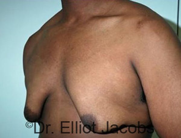Adolescent Gynecomastia Before & After Gallery - Patient 120163374 - Image 3