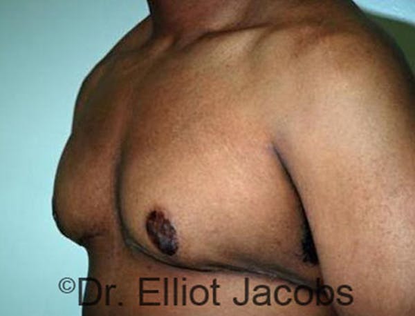 Adolescent Gynecomastia Before & After Gallery - Patient 120163374 - Image 4