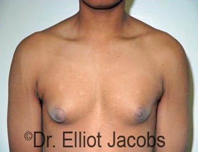 Adolescent Gynecomastia Before & After Gallery - Patient 120163375 - Image 1