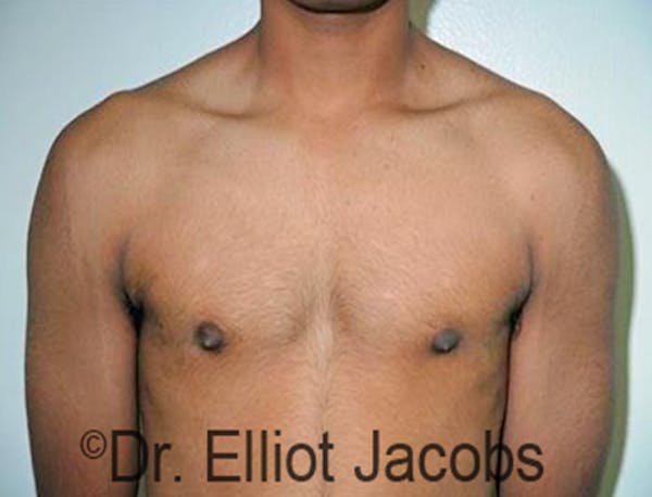 Adolescent Gynecomastia Before & After Gallery - Patient 120163375 - Image 2