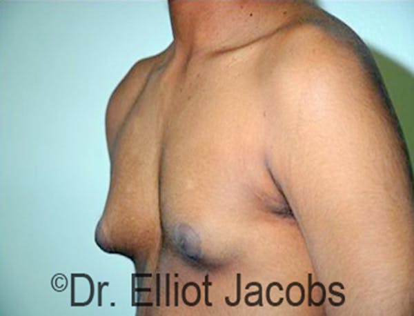 Adolescent Gynecomastia Before & After Gallery - Patient 120163375 - Image 3
