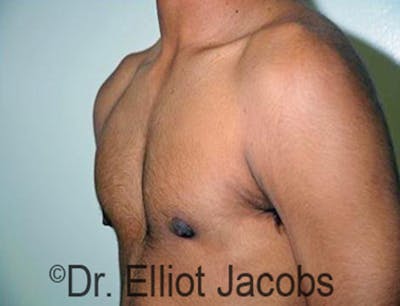 Adolescent Gynecomastia Before & After Gallery - Patient 120163375 - Image 4