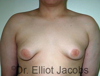Adolescent Gynecomastia Before & After Gallery - Patient 120163376 - Image 1