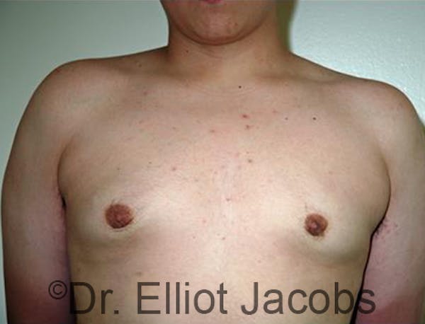 Adolescent Gynecomastia Before & After Gallery - Patient 120163376 - Image 2