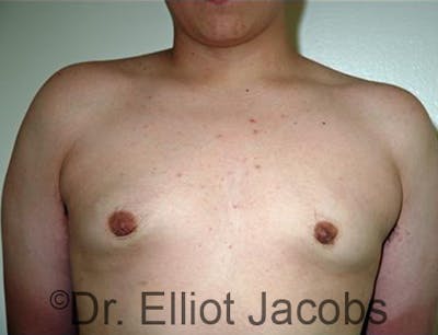Adolescent Gynecomastia Before & After Gallery - Patient 120163376 - Image 2