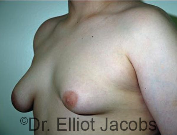 Adolescent Gynecomastia Before & After Gallery - Patient 120163376 - Image 3