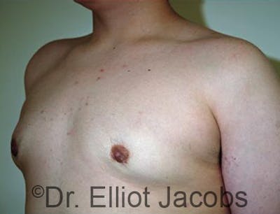 Adolescent Gynecomastia Before & After Gallery - Patient 120163376 - Image 4