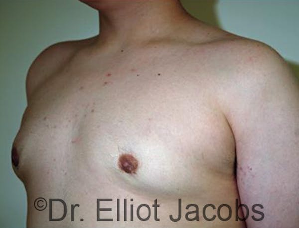 Adolescent Gynecomastia Before & After Gallery - Patient 120163376 - Image 4
