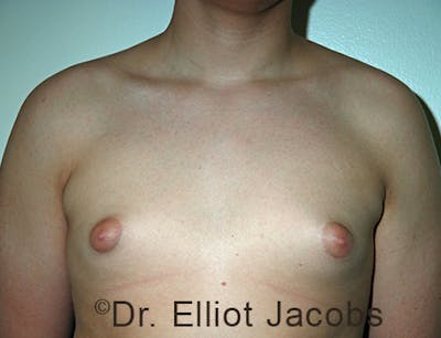 Adolescent Gynecomastia Before & After Gallery - Patient 120163377 - Image 1