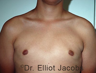 Adolescent Gynecomastia Before & After Gallery - Patient 120163377 - Image 2
