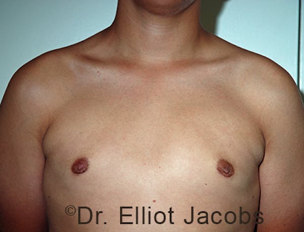 Adolescent Gynecomastia Before & After Gallery - Patient 120163377 - Image 2