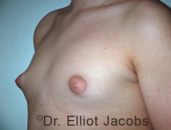 Adolescent Gynecomastia Before & After Gallery - Patient 120163377 - Image 3