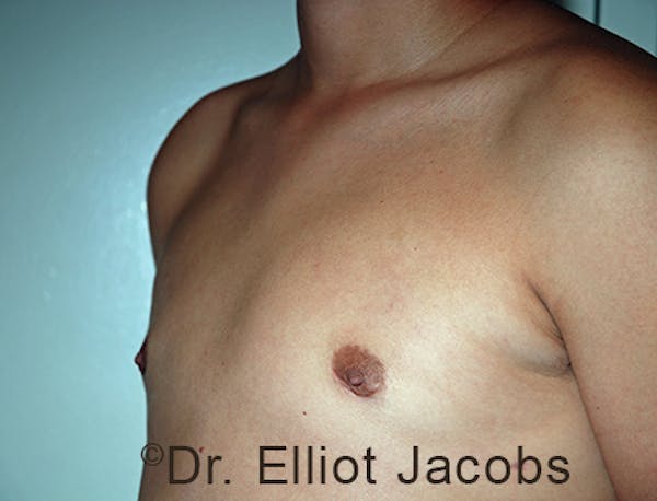 Adolescent Gynecomastia Before & After Gallery - Patient 120163377 - Image 4