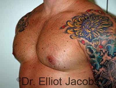 Body Builders Before & After Gallery - Patient 120163405 - Image 4