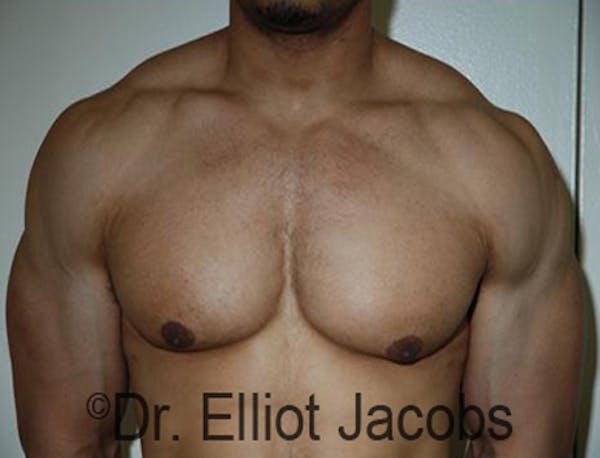 Body Builders Before & After Gallery - Patient 120163407 - Image 2