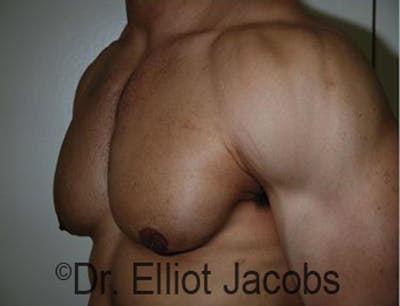 Body Builders Before & After Gallery - Patient 120163407 - Image 4