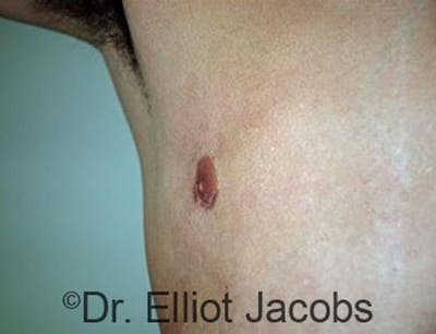 Crater Deformities Before & After Gallery - Patient 120163424 - Image 4