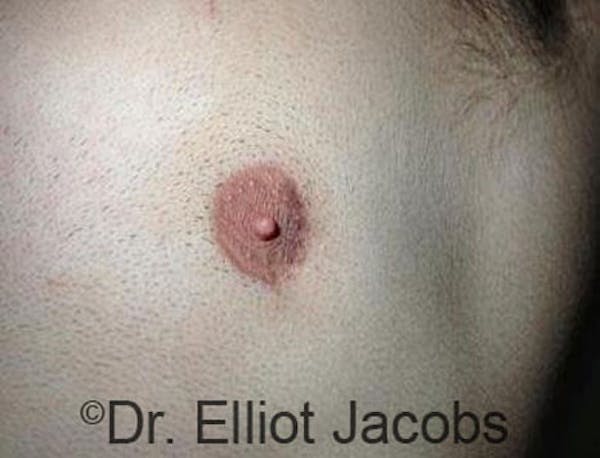 Crater Deformities Before & After Gallery - Patient 120163425 - Image 3