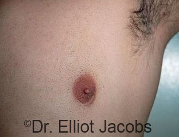 Crater Deformities Before & After Gallery - Patient 120163425 - Image 4