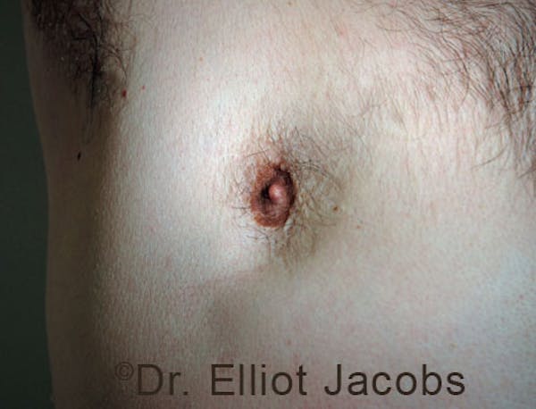 Crater Deformities Before & After Gallery - Patient 120163428 - Image 3