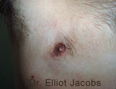 Crater Deformities Before & After Gallery - Patient 120163428 - Image 4