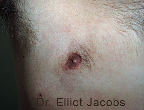 Crater Deformities Before & After Gallery - Patient 120163428 - Image 4