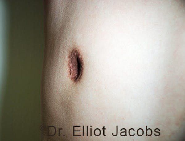 Crater Deformities Before & After Gallery - Patient 120163429 - Image 3