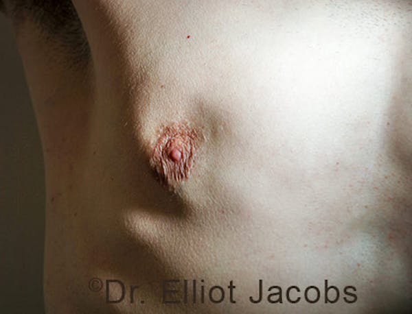 Crater Deformities Before & After Gallery - Patient 120163430 - Image 3
