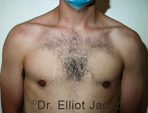 Crater Deformities Before & After Gallery - Patient 120163431 - Image 3